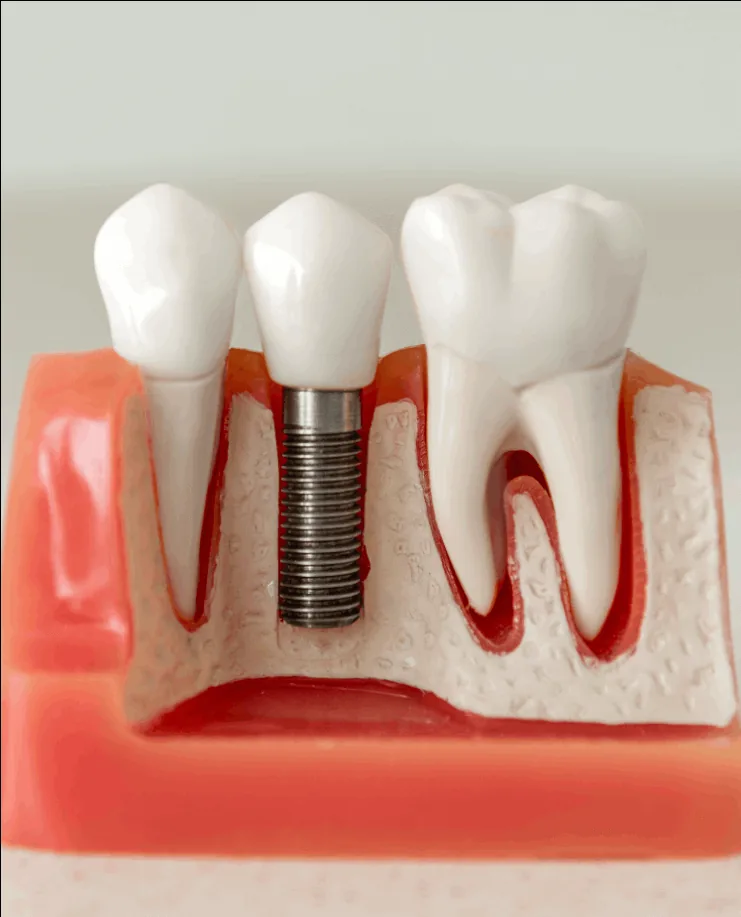 Dental implant model with titanium screw between tooth crowns and simulated gum tissue