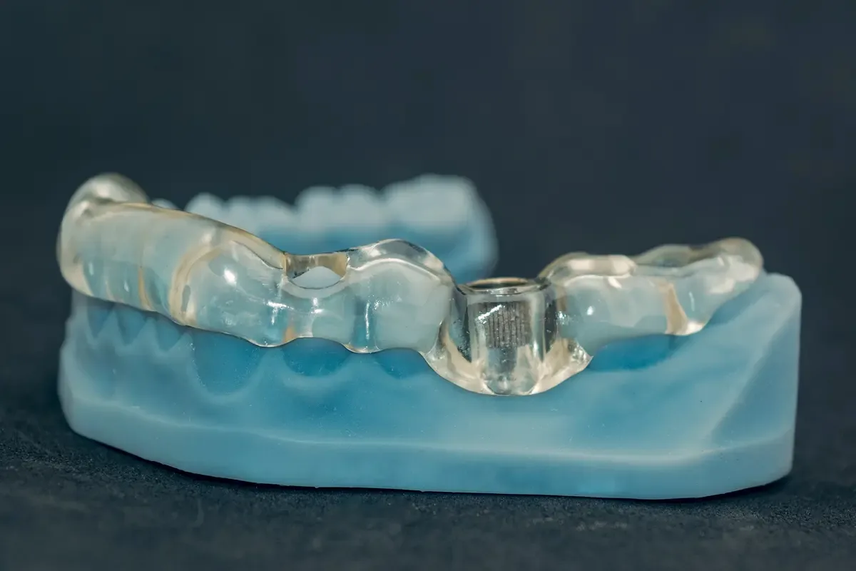 Dental bridge prosthetic with metal clasps on a blue study model